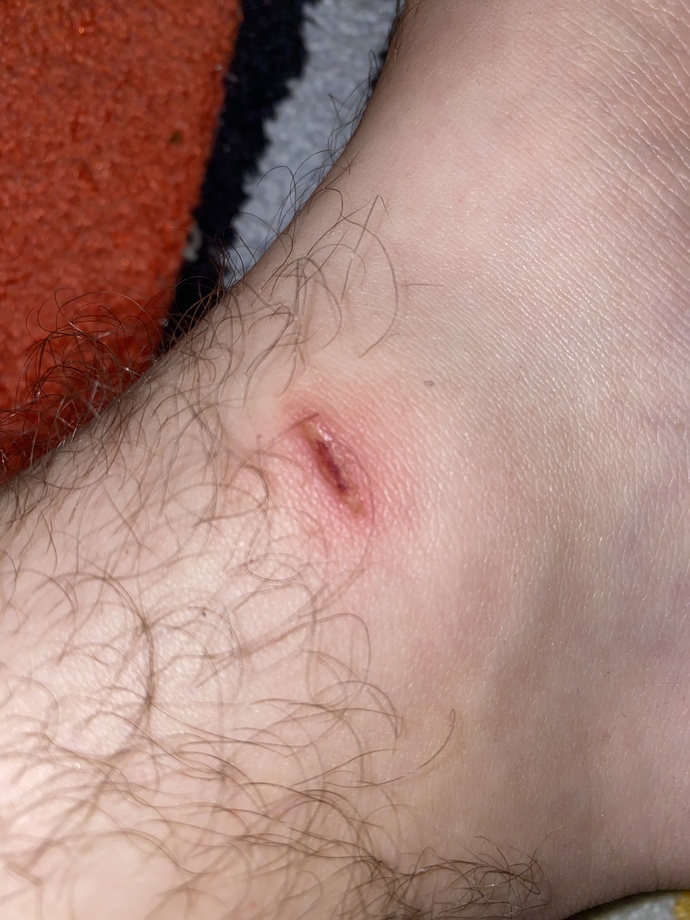 Will This Wound Leave a Scar?