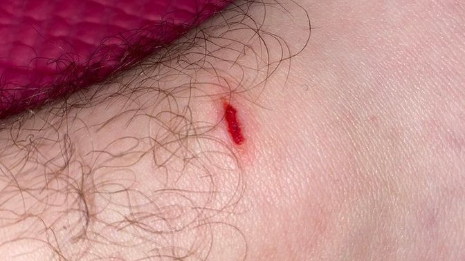 Will This Wound Leave a Scar?