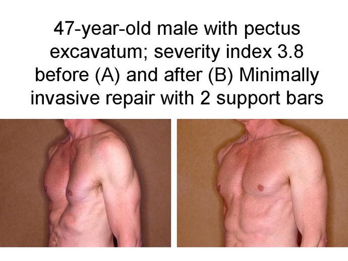 Girls, would you date someone with pectus excavatum?