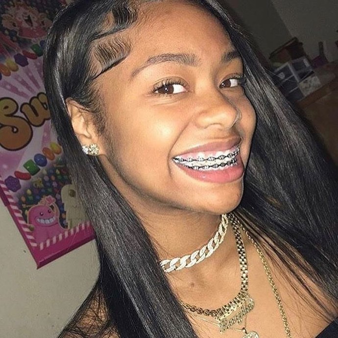 What color should I get for my braces today ?