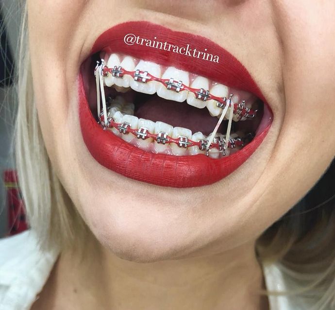 What color should I get for my braces today ?