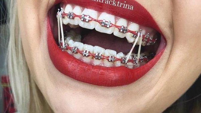What color should I get for my braces today?