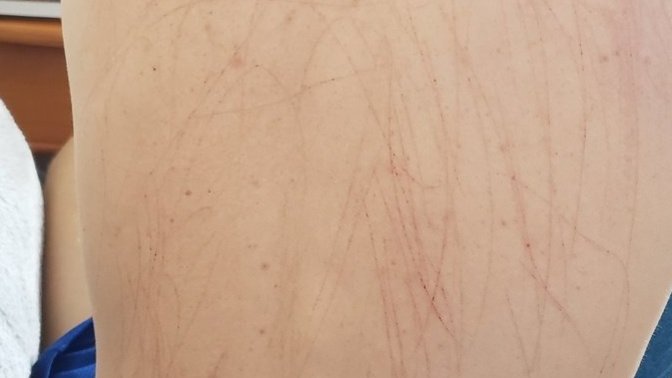 Excessive scratch marks on boyfriends back evidence of cheating?