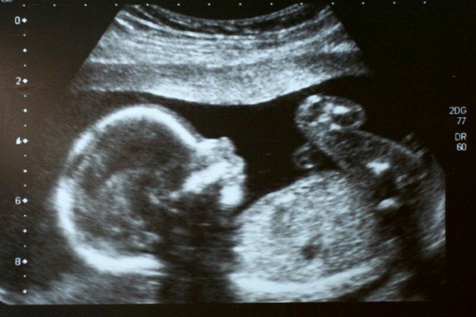 Whats your opinion on abortion?