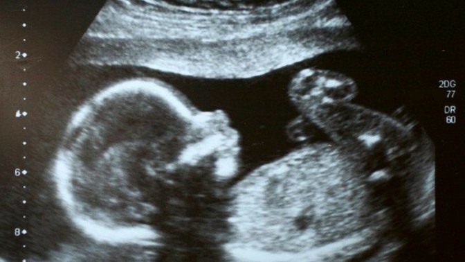 Whats your opinion on abortion?
