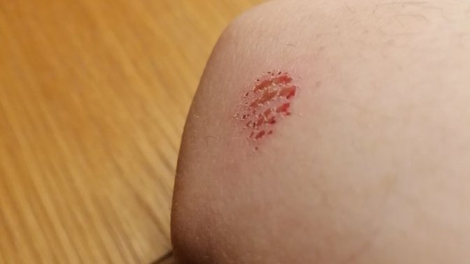 Will this leave a permanent scar?