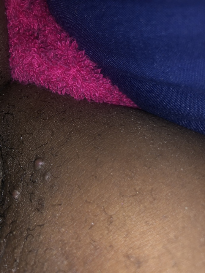 Saw these bumps on my inner thigh what could it be?