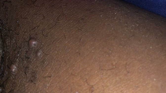 Saw these bumps on my inner thigh what could it be?
