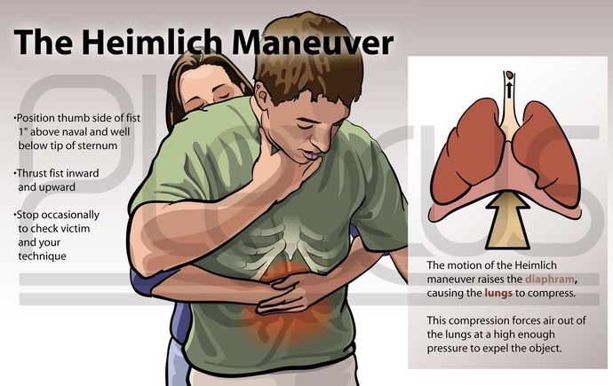 Have You Ever Given Someone The Heimlich Maneuver To Save Their Life?