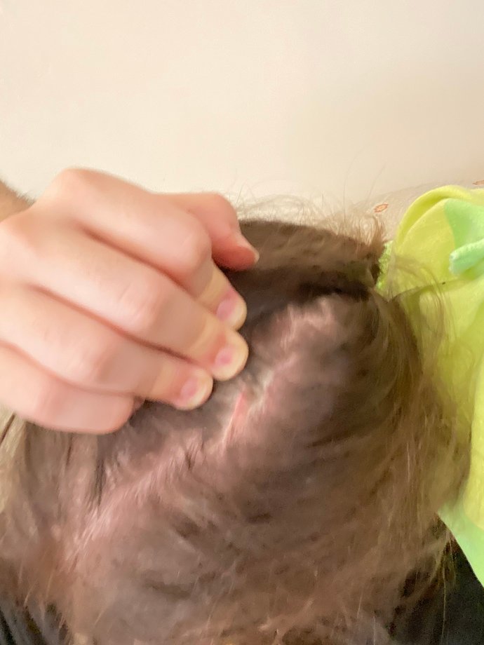 How can I get rid of this scar?