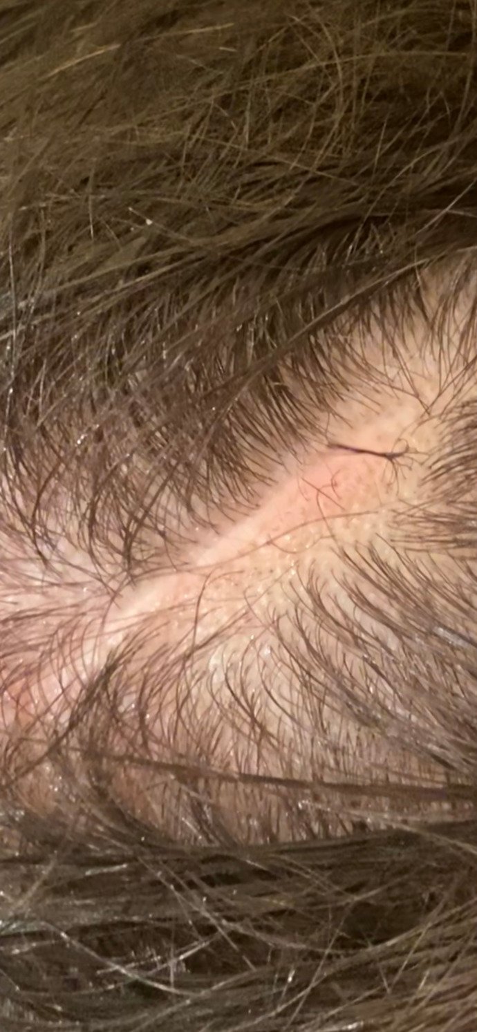 How can I get rid of this scar?