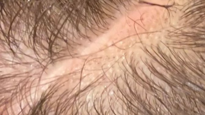 How can I get rid of this scar?