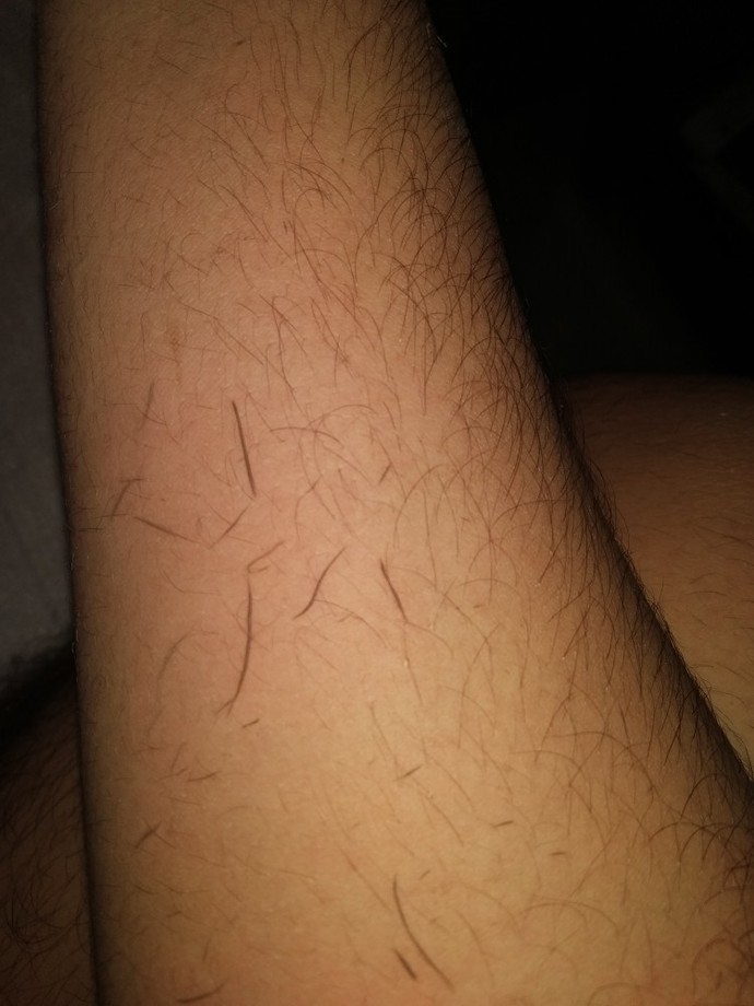 Do white people get scum in their skin?