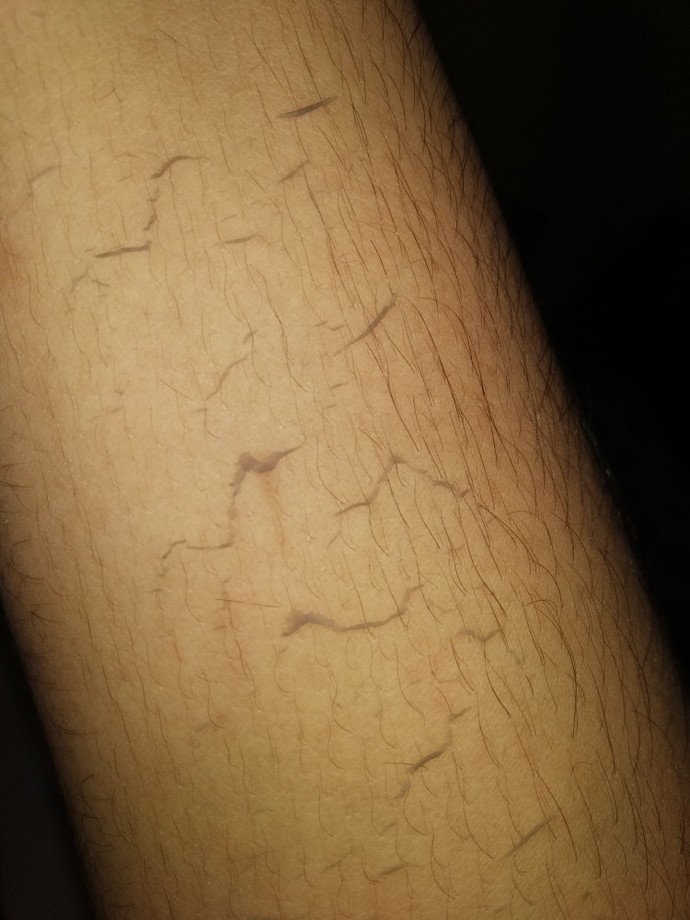 Do white people get scum in their skin?