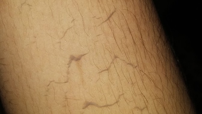 Do white people get scum in their skin?