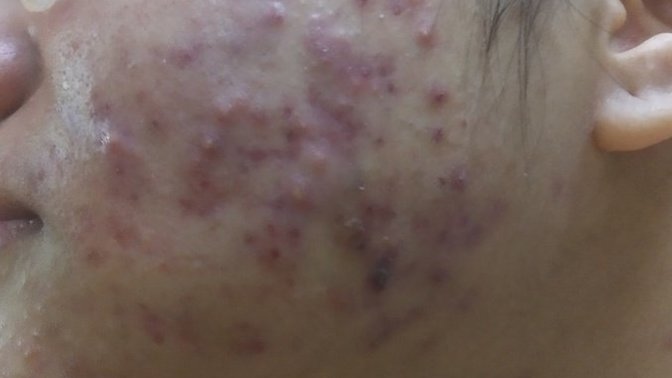 Guys, are you disgusted to see a woman who has bad acne?