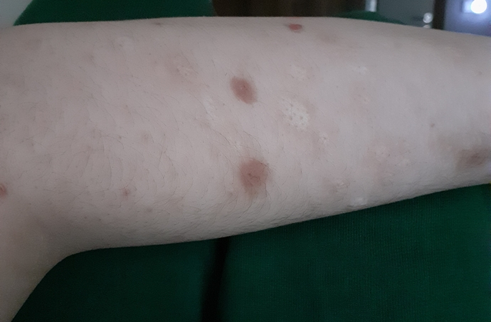 I have dermatillomania? Can I hide my scars with a tattoo?