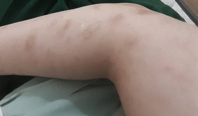 I have dermatillomania? Can I hide my scars with a tattoo?