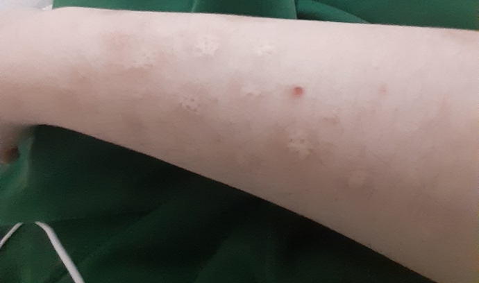 I have dermatillomania? Can I hide my scars with a tattoo?