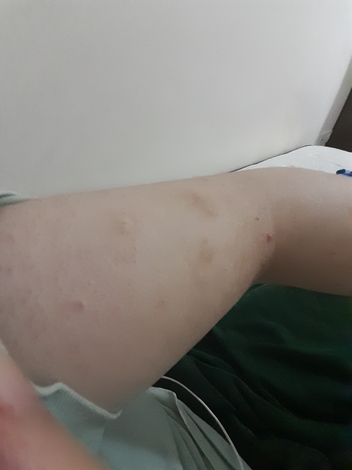 I have dermatillomania? Can I hide my scars with a tattoo?