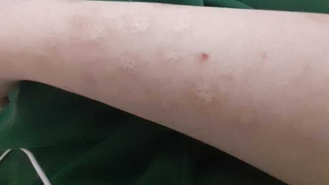 I have dermatillomania? Can I hide my scars with a tattoo?
