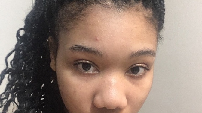 How to get rid of acne quickly?