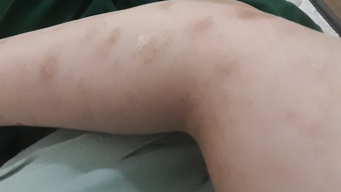 Is scar treatment possible?