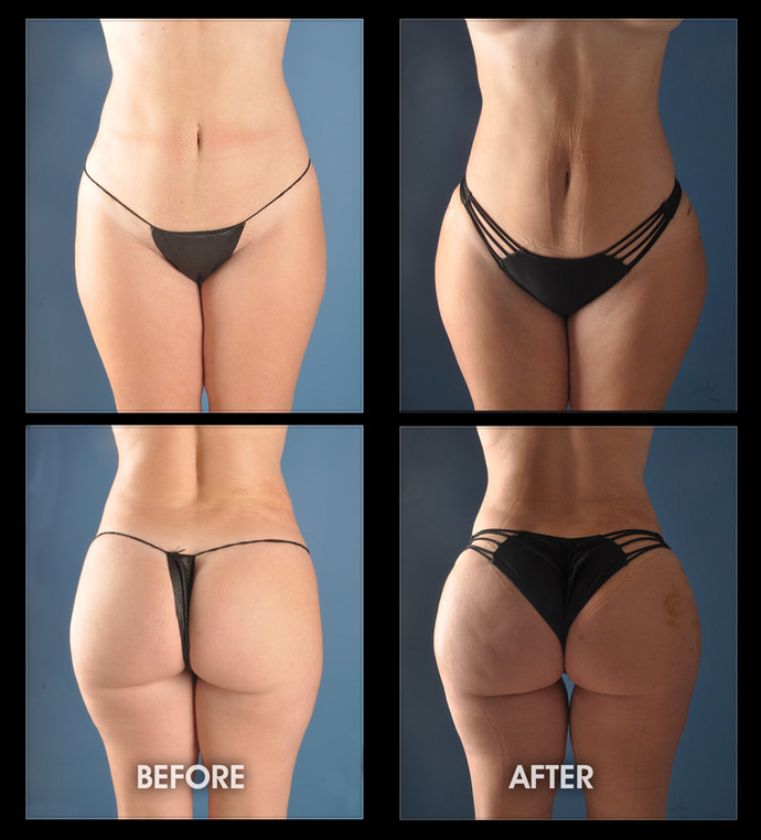 What do you think of a guy getting hip and butt implants?