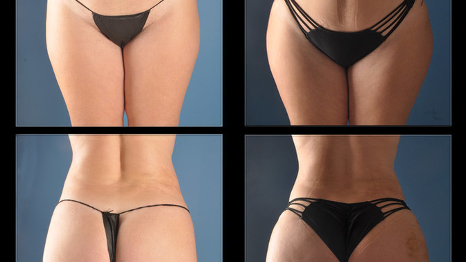 What do you think of a guy getting hip and butt implants?