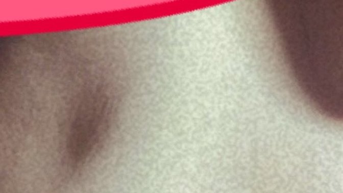 I have a dimple on my boobs should I get it checked please check picture?