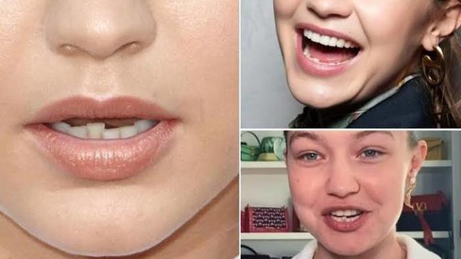 Are crooked teeth a turn off while kissing?