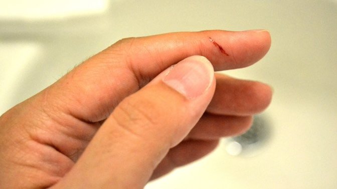 What is the most painful MINOR injury you have ever experienced?