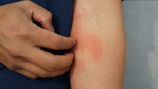 Anyone else have an allergic reaction to second dose of Covid vaccine?