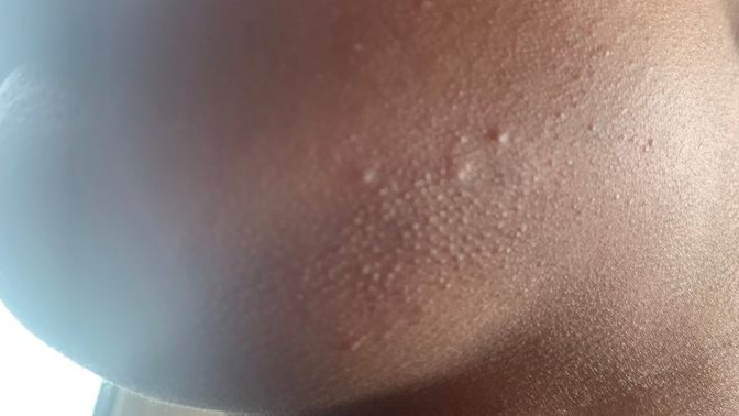 How to get rid of acne?