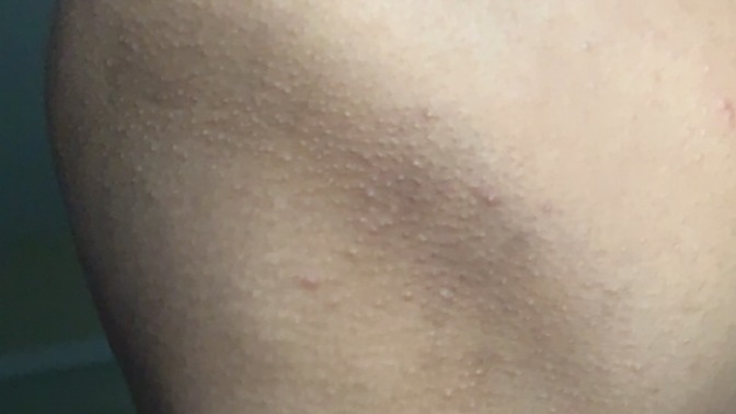Girls, How do you treat a fungus?