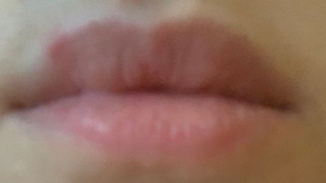 Is this herpes?
