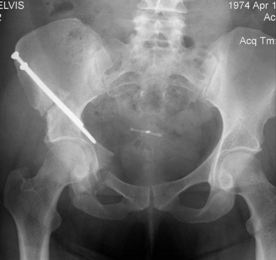 What’s the most physically painful thing to have ever happened to you?