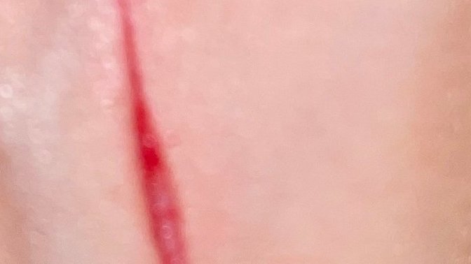 Do I need stitches for this hand cut (pic) ?
