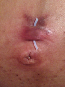 infected belly button from piercing