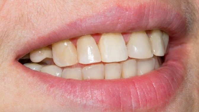 Guys, are teeth like these (or slightly "worse") a dealbreaker in dating?