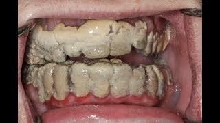 What happens when you don't brush your teeth?