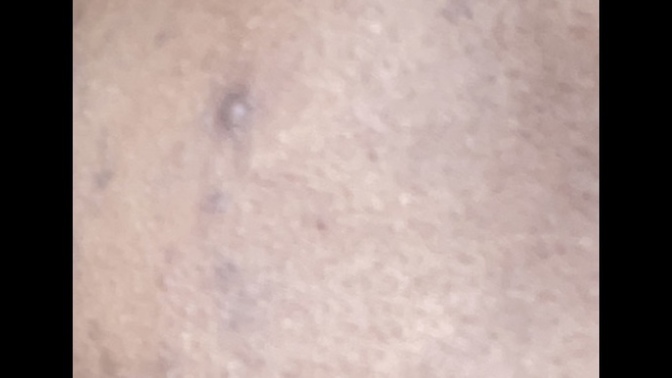 What fades your acne scars?