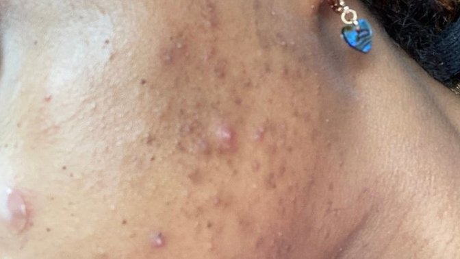 Can anyone give me tips on what I can use for my acne?