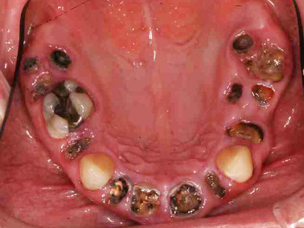 Are having bad teeth a deal breaker for you in dating?