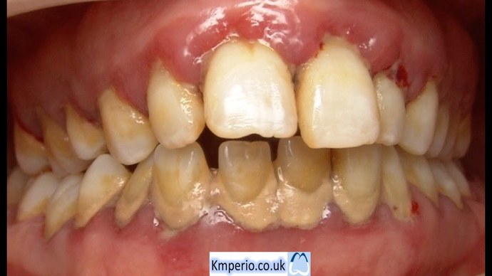 Are having bad teeth a deal breaker for you in dating?