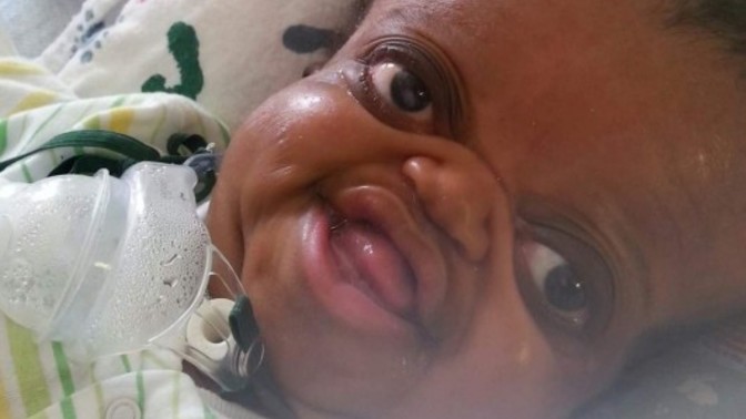 If your child came out like looking like this along with many other medical problems would you keep it?