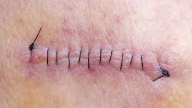 How to hide stiches?