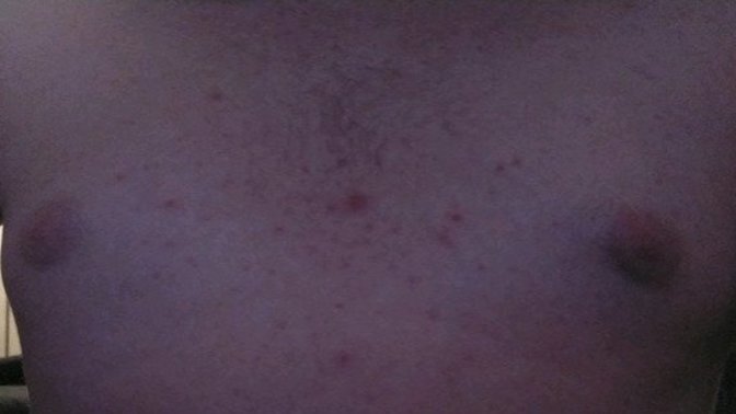 Girls, have you dated a guy with a minor gynecomastia problem?