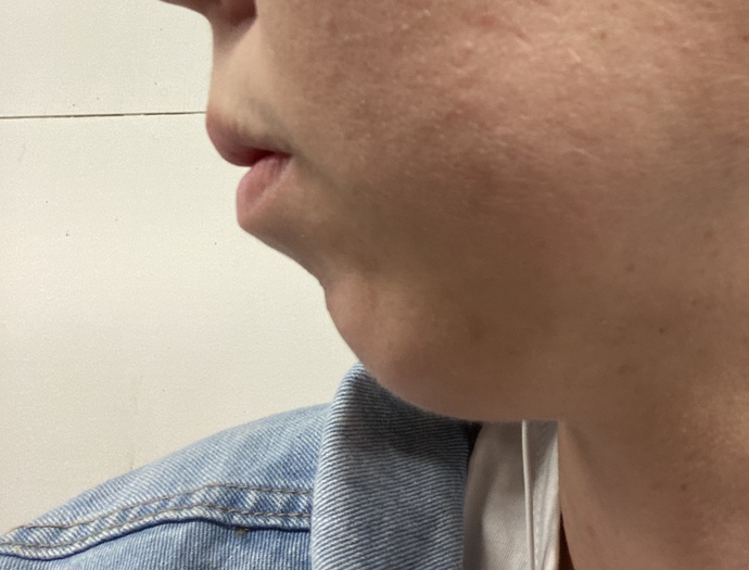Do you think I should get chin surgery for my receding chin?