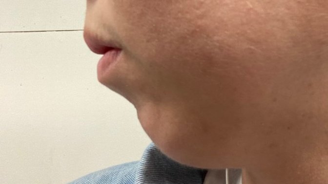 Do you think I should get chin surgery for my receding chin?